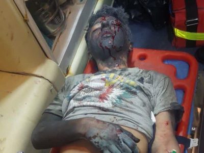 آسیب شدید به هر دو چشم پسر ۱۶ ساله بر اثر انفجار ترقه